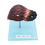 간염/경변/암 간의 이상모형 (KSIC-6519)